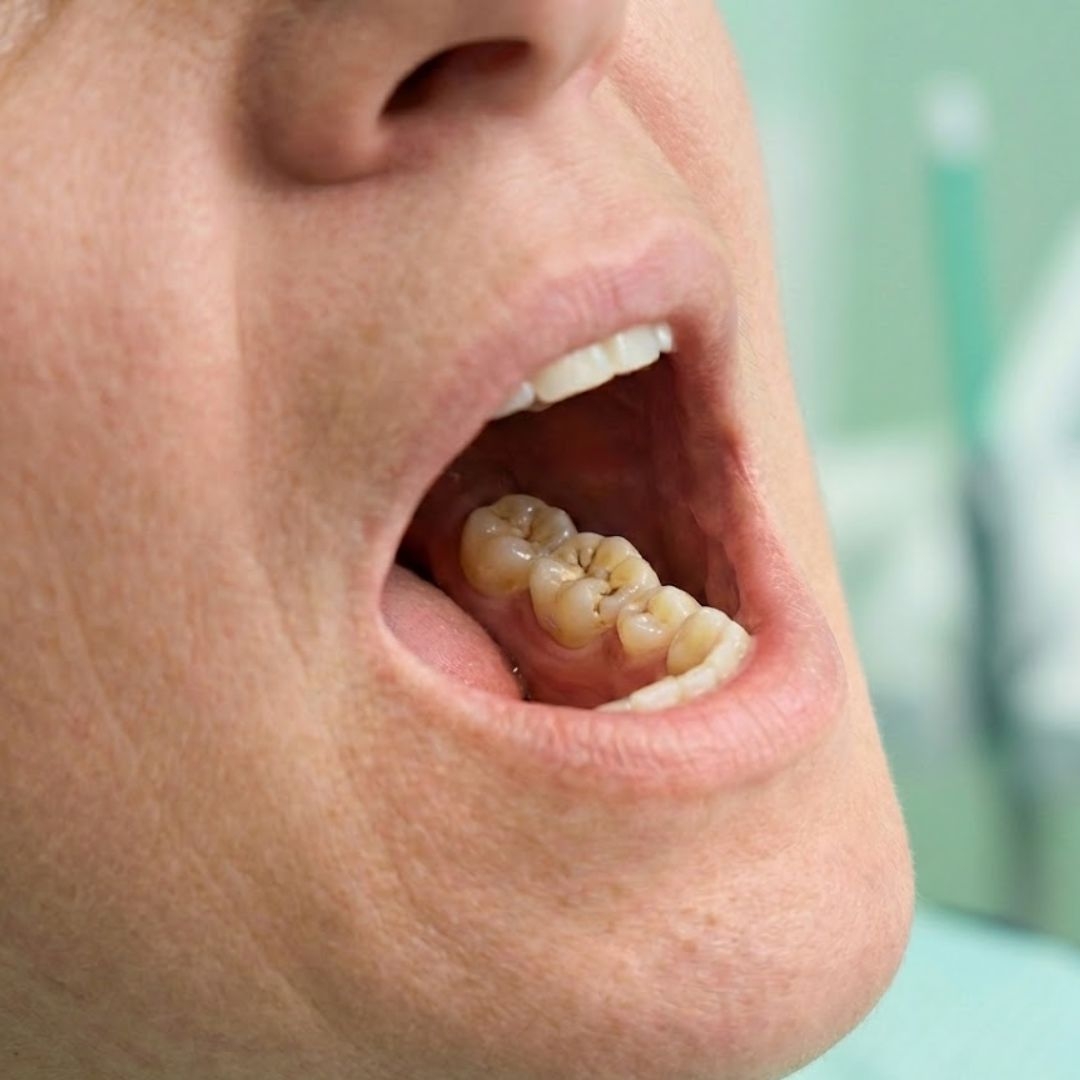 Tooth cavity symptoms – Close-up of open mouth: one molar shows a small brown‑black pit on the chewing surface; surrounding gums are pink. Image generated by AI