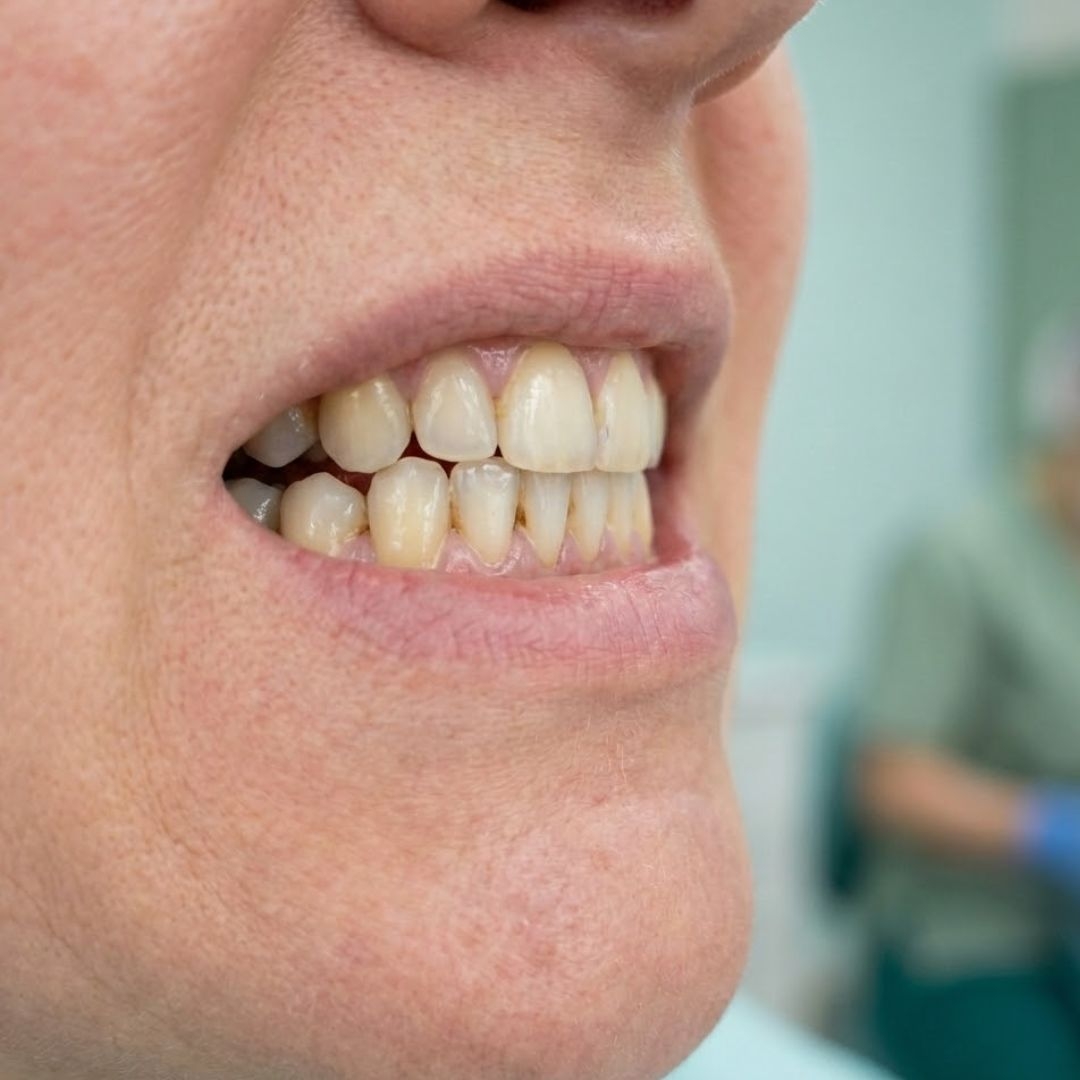 Tartar (dental calculus) symptoms – yellowish, hard deposits at the gumline with multiple patches and an uneven surface, illustrative image. Image generated by AI